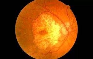 Абиотрофия сетчатки глаза