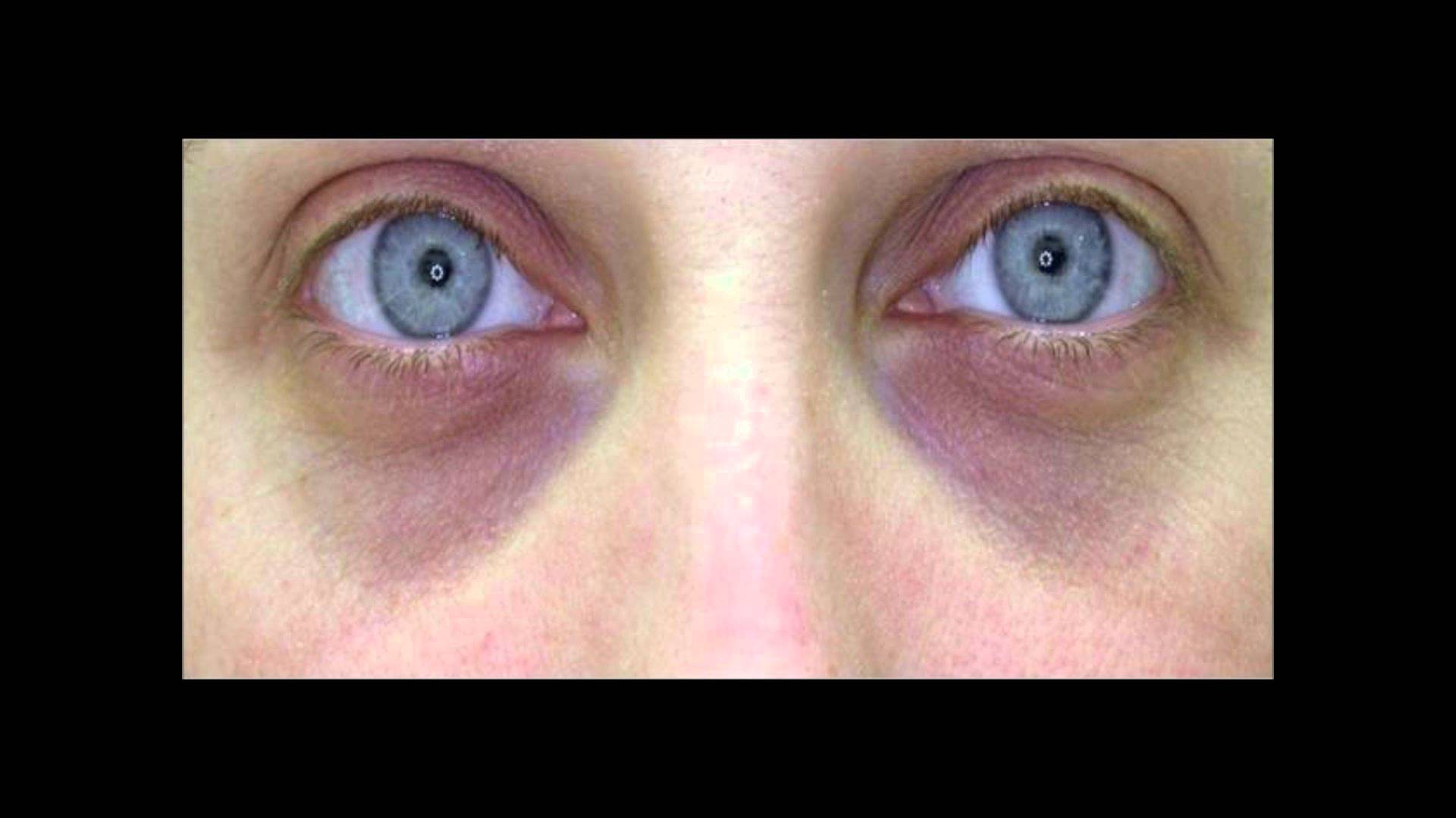 Синяки под глазами у мужчин - причины, лечение