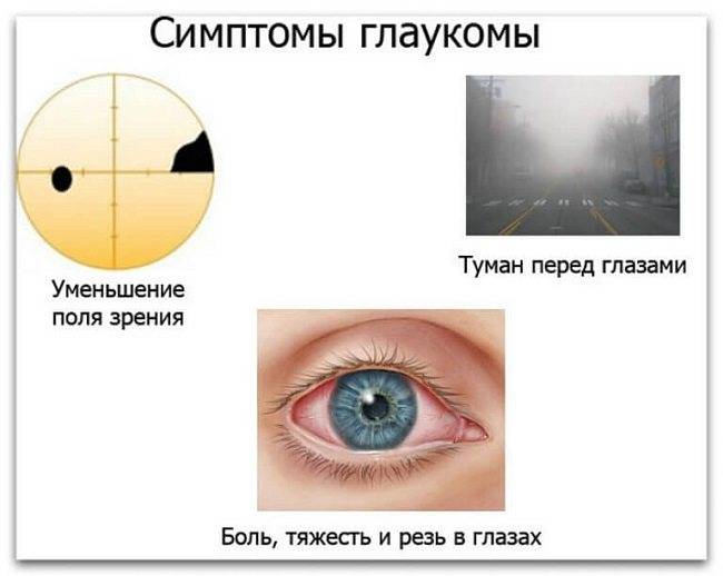 Признаки глаукомы на разных стадиях развития заболевания