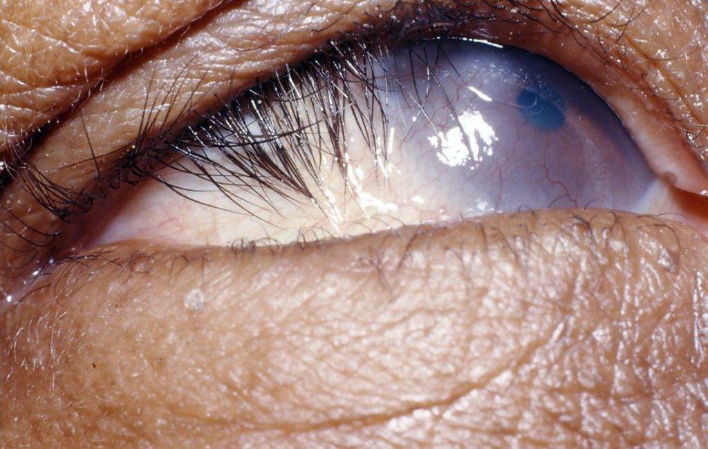 Трахома глаз: причины, симптомы и методы лечения - "здоровое око"