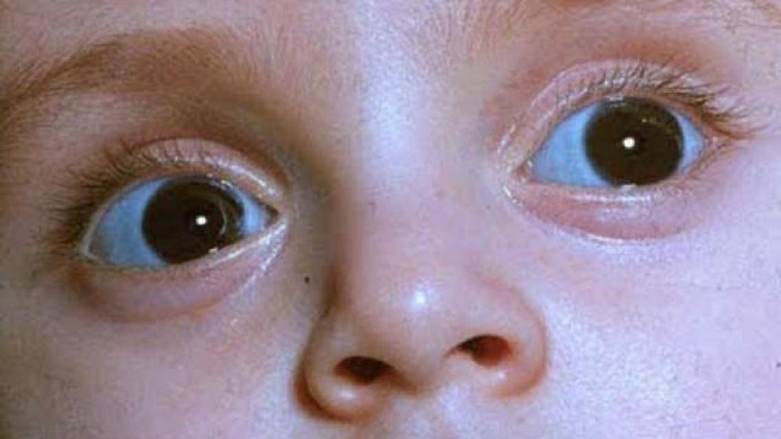 Означают голубые белки глаз. голубые (синие) склеры