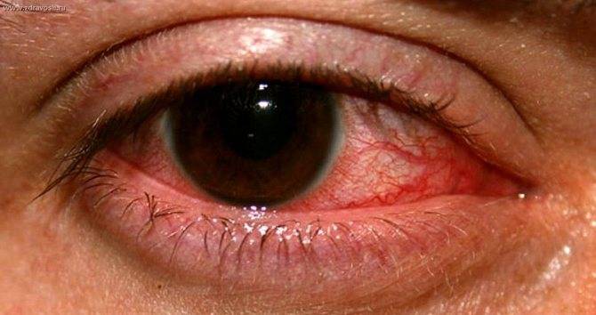 Грибок на глазах: основные симптомы и способы лечения