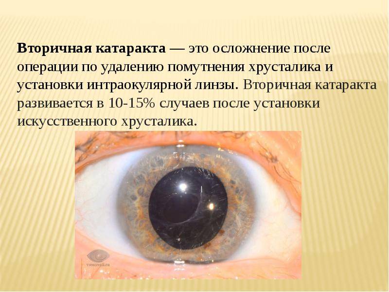 Вторичная катаракта после замены хрусталика: лечение глаза с искусственным хрусталиком, причины и симптомы