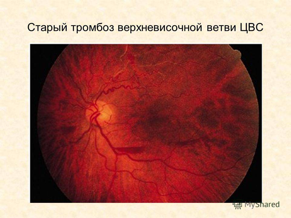 Тромбоз центральной вены сетчатки глаза: лечение и причины