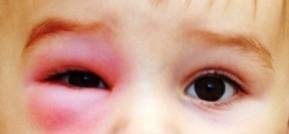 Ячмень на глазу у ребенка: как лечить, что делать, причины, симптомы, фото