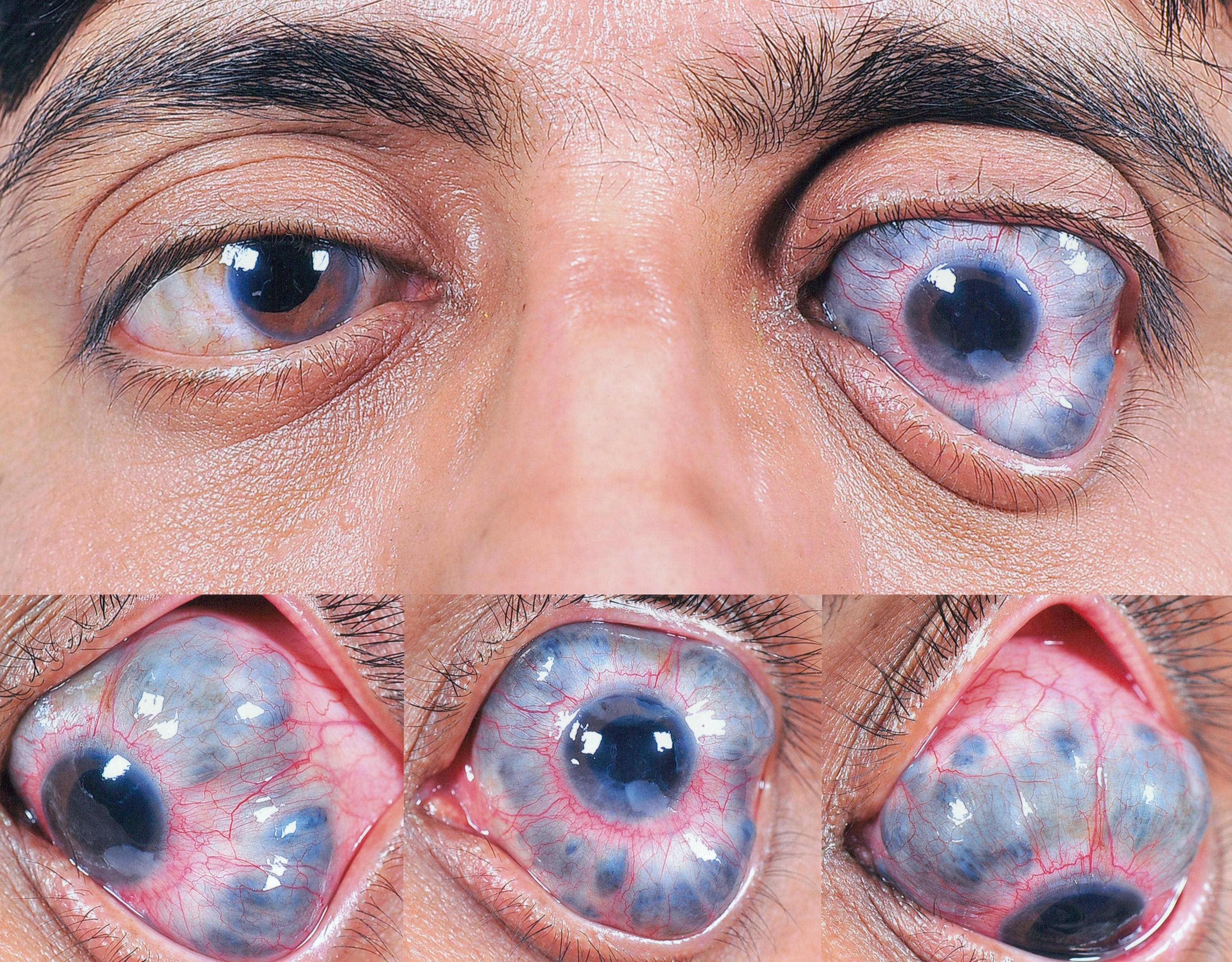 Энуклеация глазного яблока: суть, побочные эффекты
