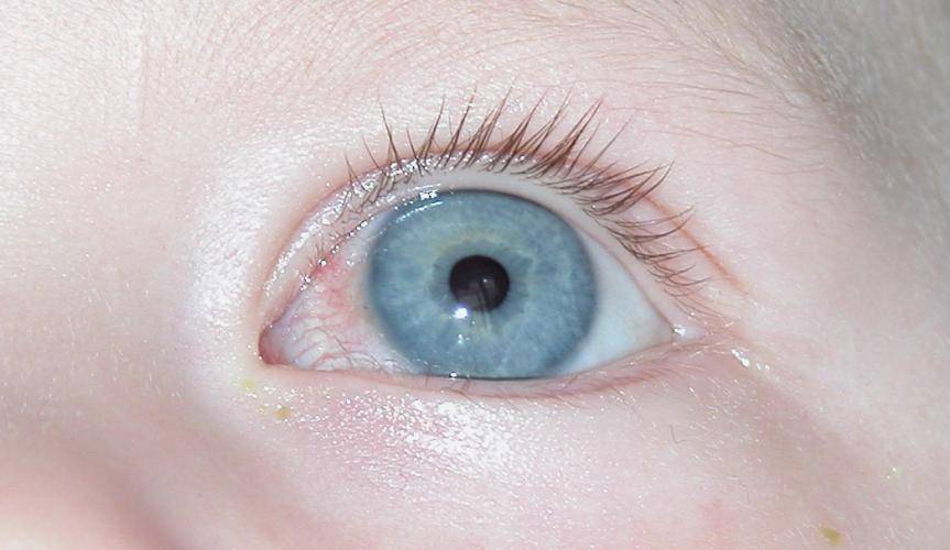 Кератит глаза - виды, причины и симптомы, методы лечения