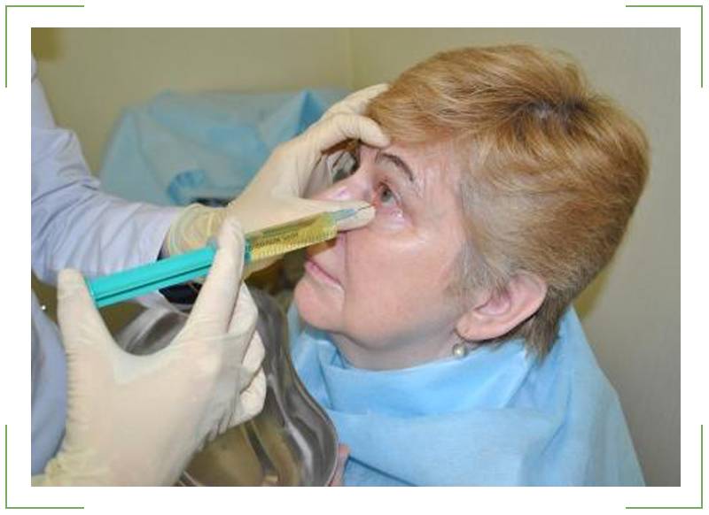 Зондирование слезного канала: понятие и методика - "здоровое око"