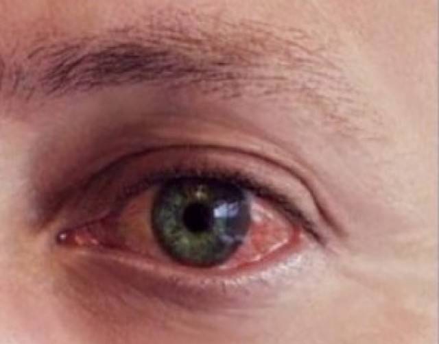 Травма глаза: классификация, первая помощь и лечение
