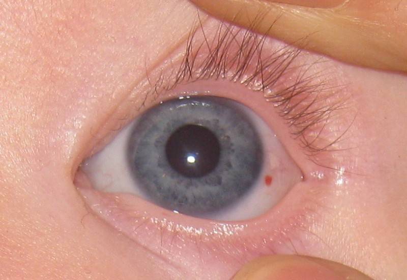 Почему белки глаз голубые