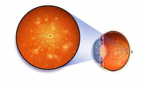 Ангиопатия сетчатки обоих глаз ои: что это такое, причины развития, симптомы, как и чем лечить