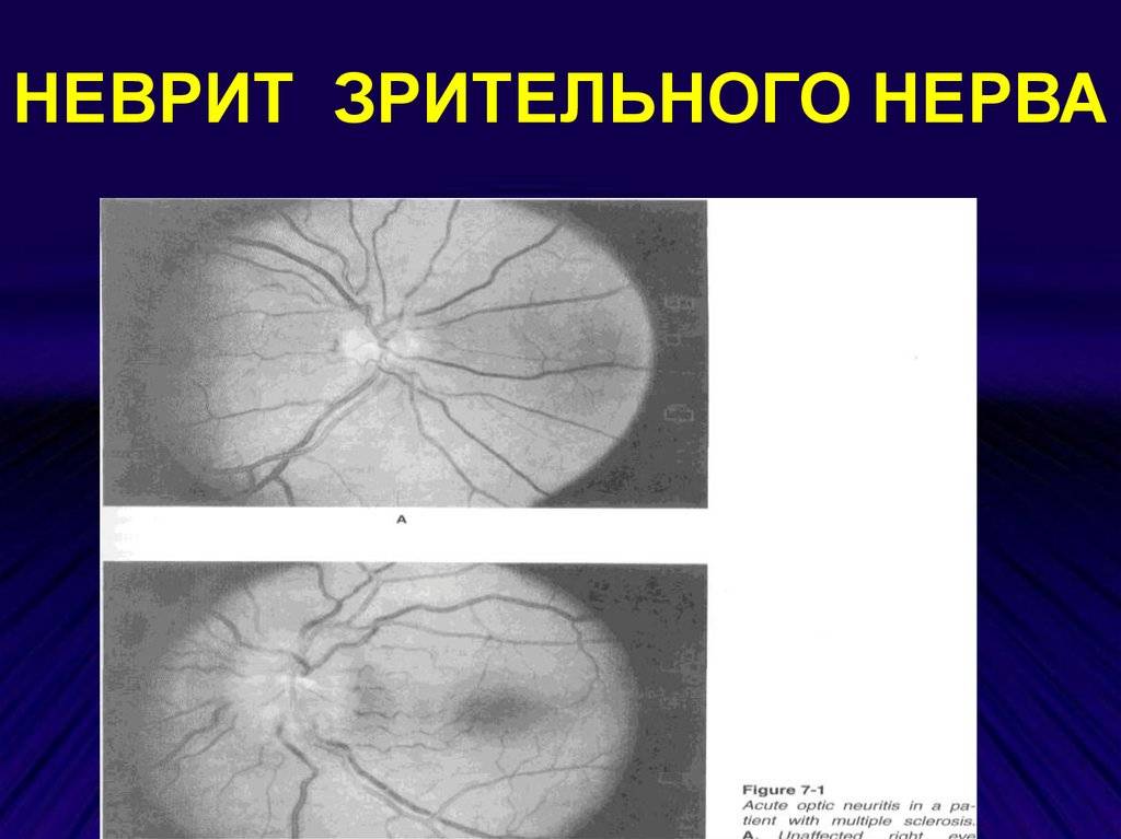Неврит зрительного нерва: симптомы и лечение воспаления, как лечить глазные нервы