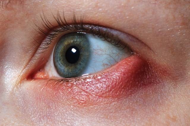 Резь в глазах и слезоточивость: причины, почему режет и чем лечить режущую боль, капли от жжения