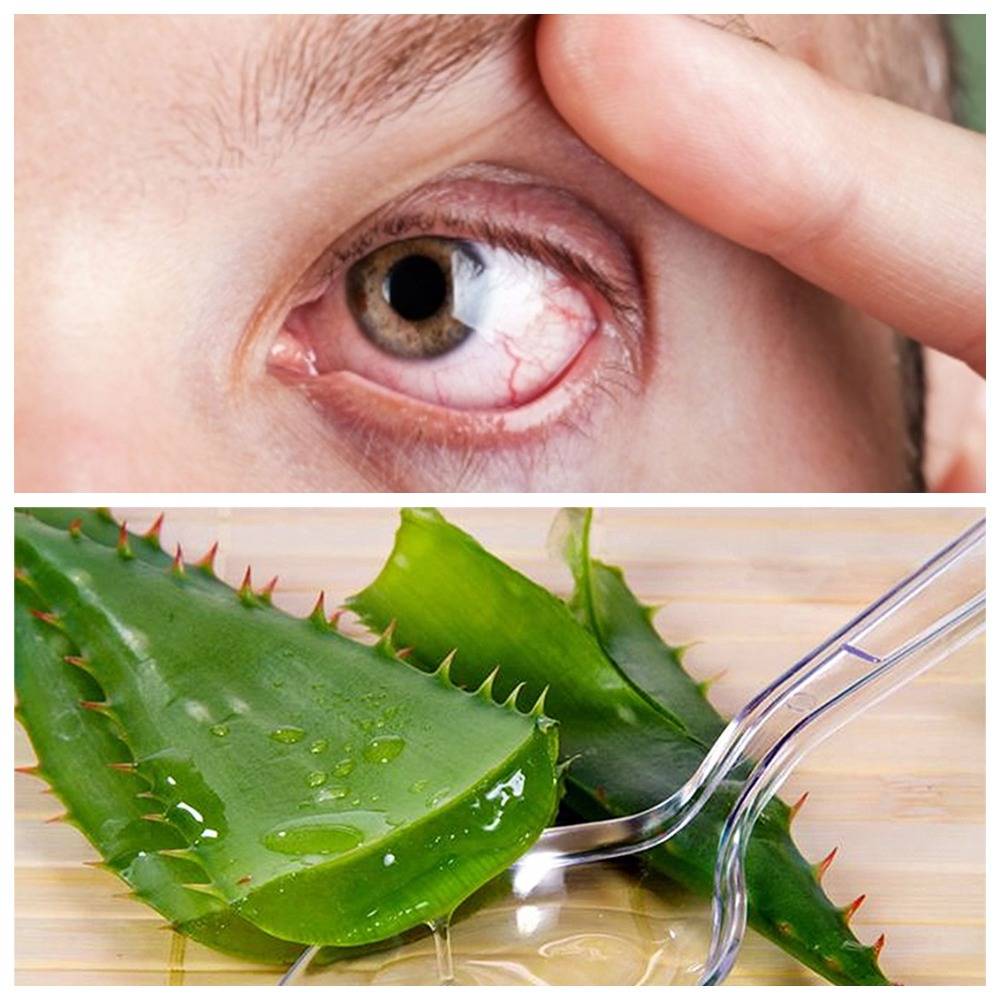 Народные средства от сухости глаз: как вылечить синдром сухого глаза в домашних условиях