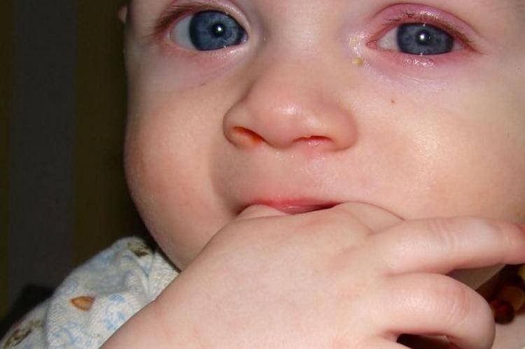 Что это может быть за болезнь: слезится глаз у ребенка 1 года и старше