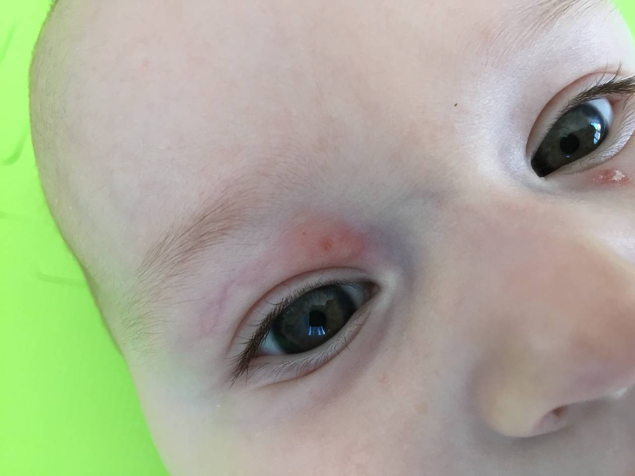 Лопнувший сосуд в глазу у ребенка - причины и лечение