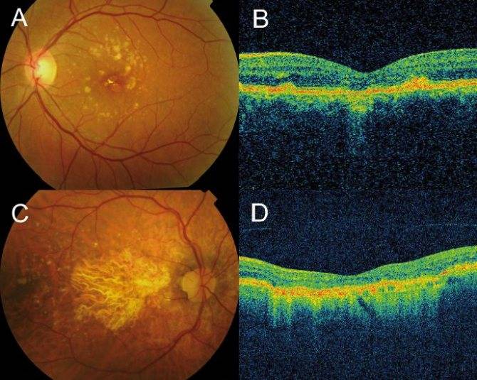 Ретиношизис сетчатки глаза — причины, симптомы и лечение (фото)