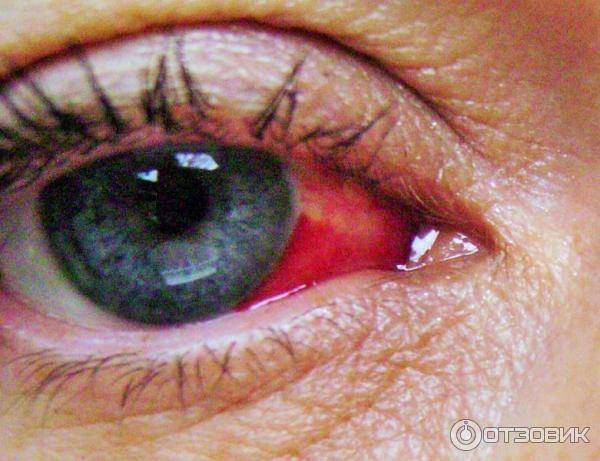 Почему появляются кровоизлияния в глаз; их виды, причины и симптомы, что делать для лечения и профилактики
