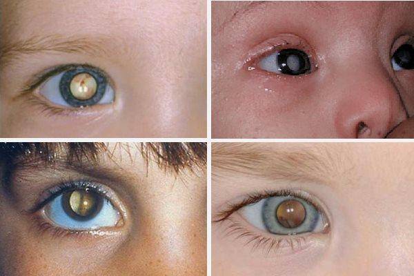 Причины, симптомы, методы излечения врожденной и других видов катаракты у детей