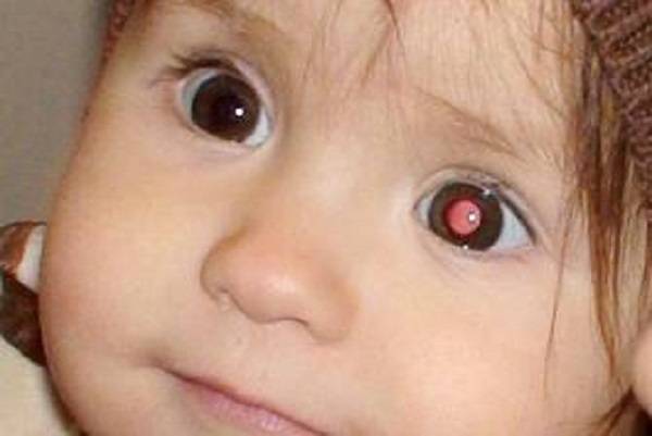 Ретинобластома глаз у детей: причины, симптомы, лечение, фото