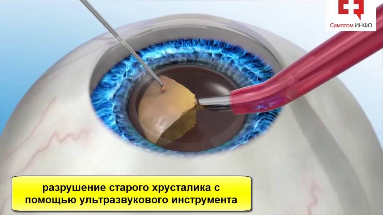 Как проходит операция по удалению катаракты