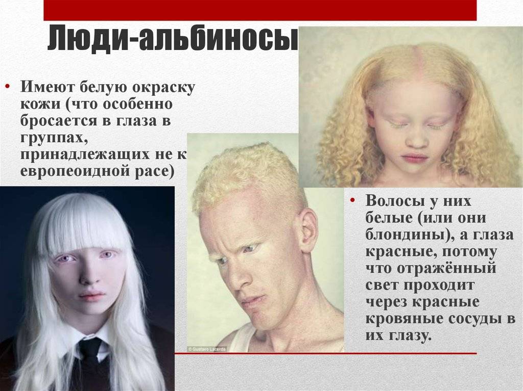 Люди альбиносы: фотографии и интересные факты