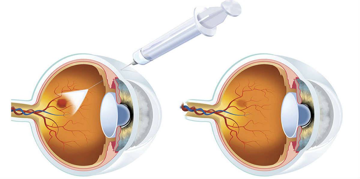 Витамины для глаз для улучшения зрения: описание и список витамин в каплях и не только