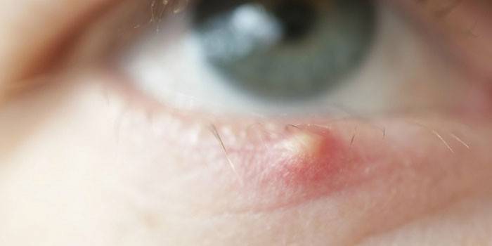 Частые рецидивирующие ячмени на глазах: истинные причины