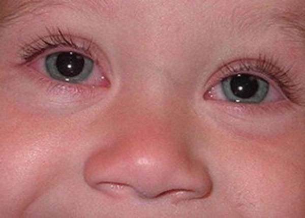 Красные глаза при простуде: основные симптомы
