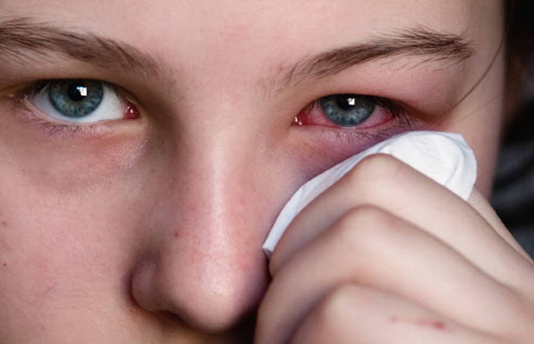 Чем лечить аллергический конъюнктивит у ребенка?