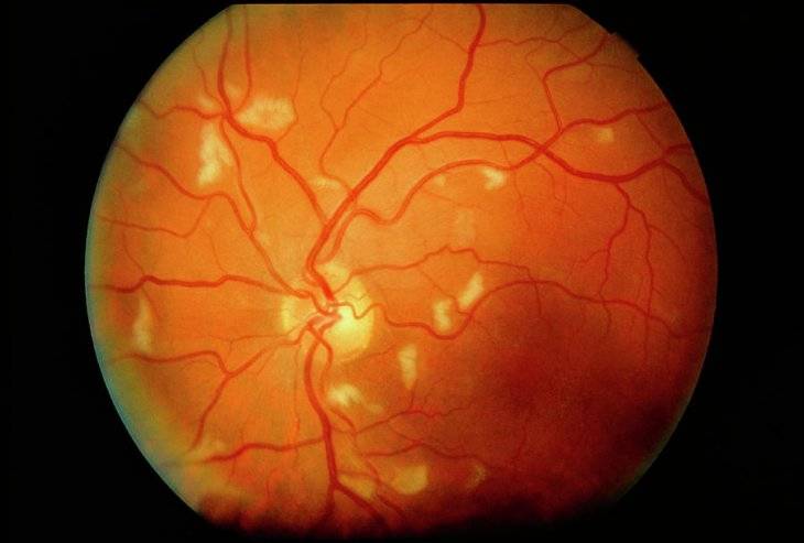 Заболевания сетчатки глаза - список болезней сосудистого происхождения, воспалительные и дистрофические, их симптомы и лечение