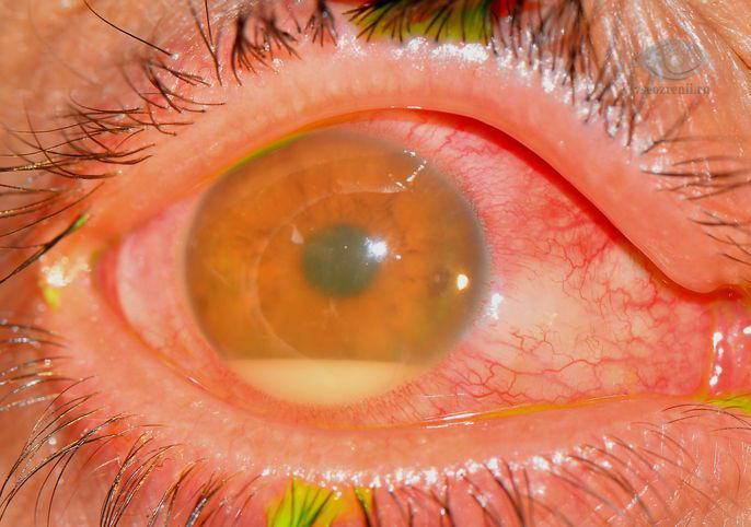 Эндофтальмит глаза – причины, симптомы и лечение эндофтальмита (фото)