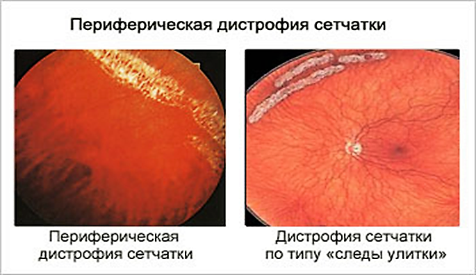 Периферическая витреохориоретинальная дистрофия сетчатки глаза: что это такое, центральная хориоретинальная форма, лечение