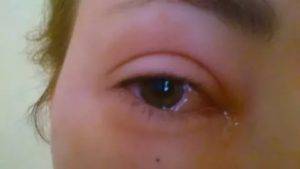 Чешутся глаза в уголках возле переносицы: причины и что делать. сайт «московская офтальмология»