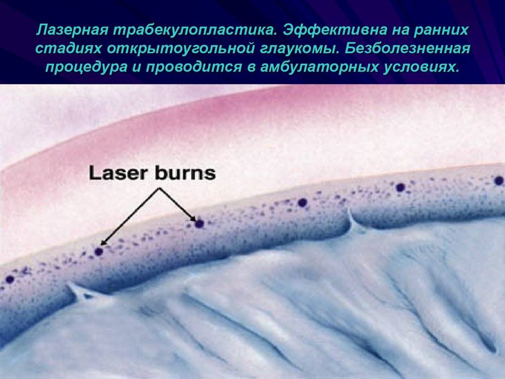 Лечение глаукомы лазером — лазерная трабекулопластика, иридэктомия, иридотомия — глаза эксперт