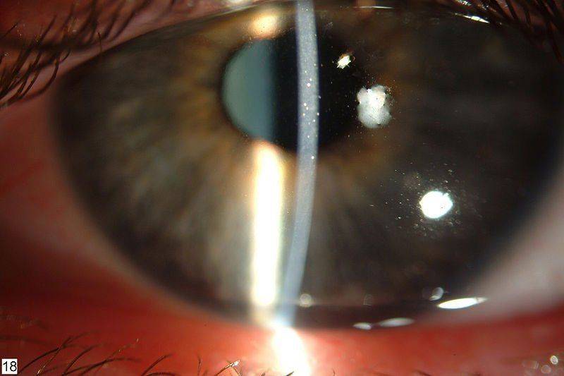 Краевой кератит глаз: причины и лечение