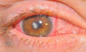 Эрозия роговицы глаза: как лечить - "здоровое око"