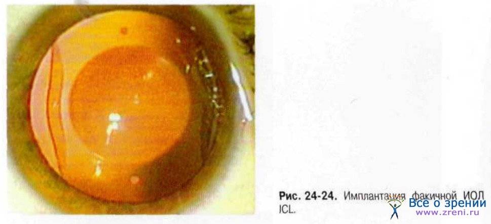 Лазерная коррекция зрения - последствия проведения операции