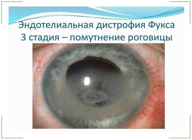 Дистрофия роговицы глаза: причины и симптомы - "здоровое око"