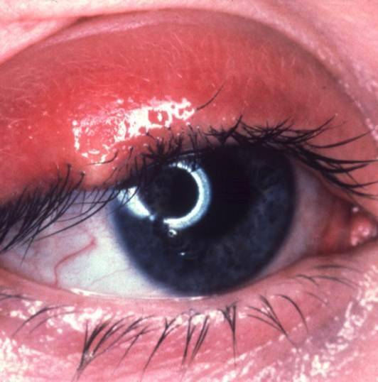 Чем опасен блефароконъюнктивит глаз и эффективные методы лечения