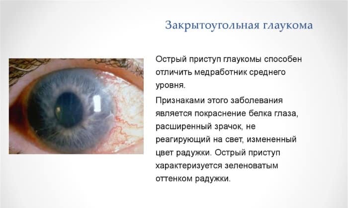 Закрытоугольная глаукома: причины, симптомы, лечение и профилактика