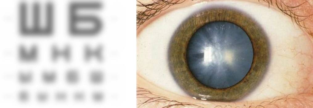 Блог о симптомах, причинах и лечении синдрома сухого глаза