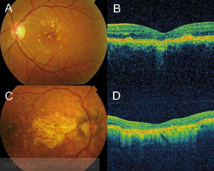 Возрастная макулодистрофия - влажная форма заболевания глаза, современные способы лечения, причины и прогноз сохранения зрения