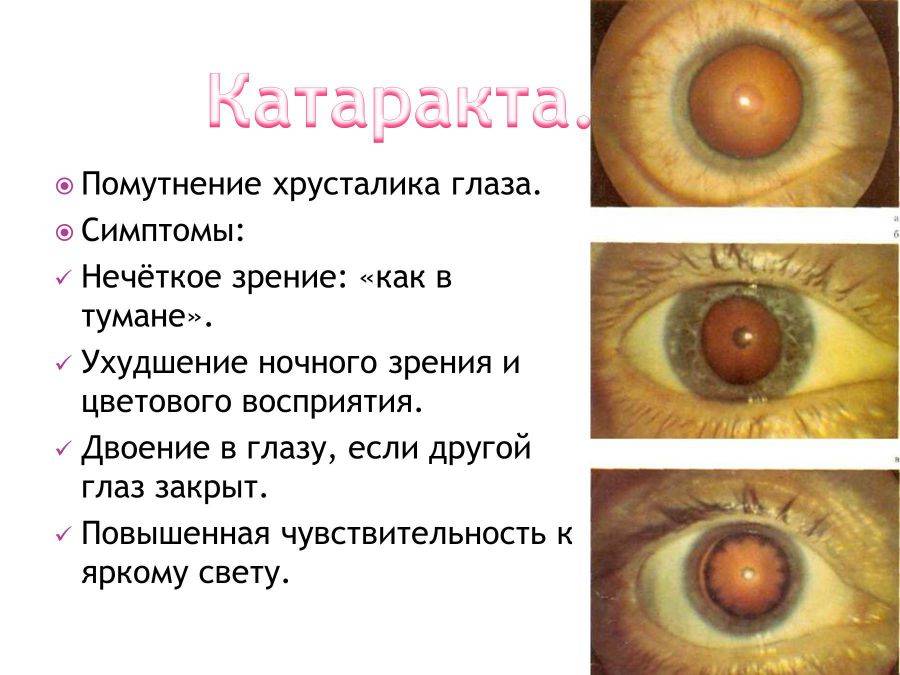 Осложнения после операции по замене хрусталика глаза