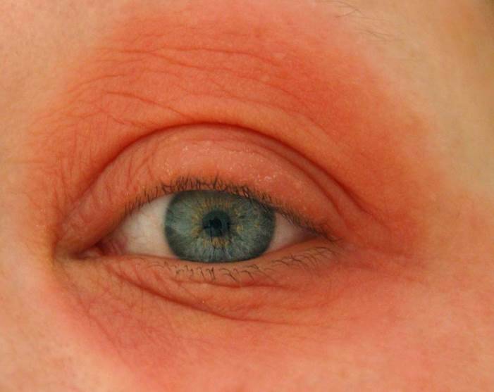 Почему у ребенка красные синяки под глазами: комаровский о причинах