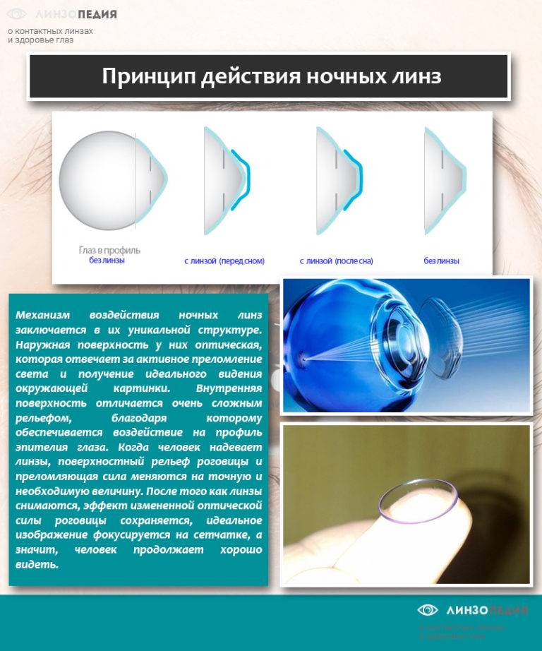 Ортокератологические ночные линзы для восстановления зрения, коррекции, отзывы врачей, раствор