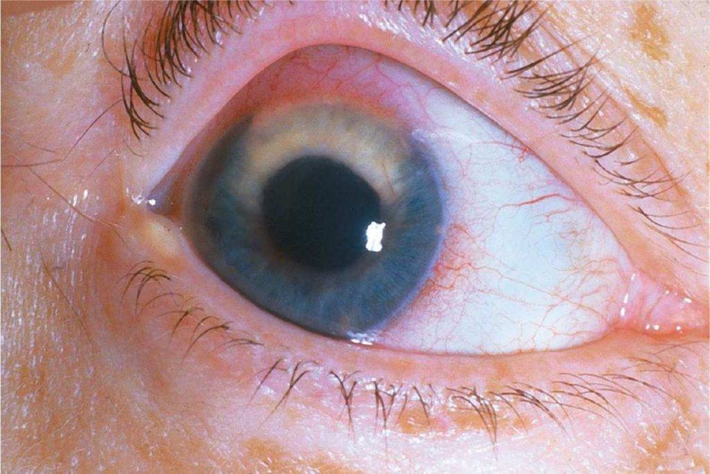 Bторичная некомпенсированная глаукома:  возникновение и лечение — глаза эксперт