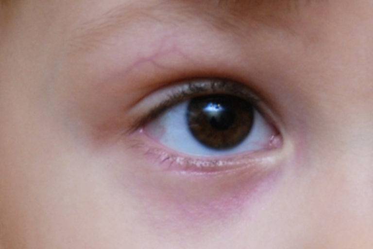 Синяки под глазами у ребенка: причины, патологии, что делать