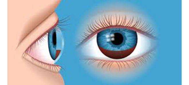 Гифема: что нужно знать о кровоизлиянии в глаз, рекомендации для заболевших