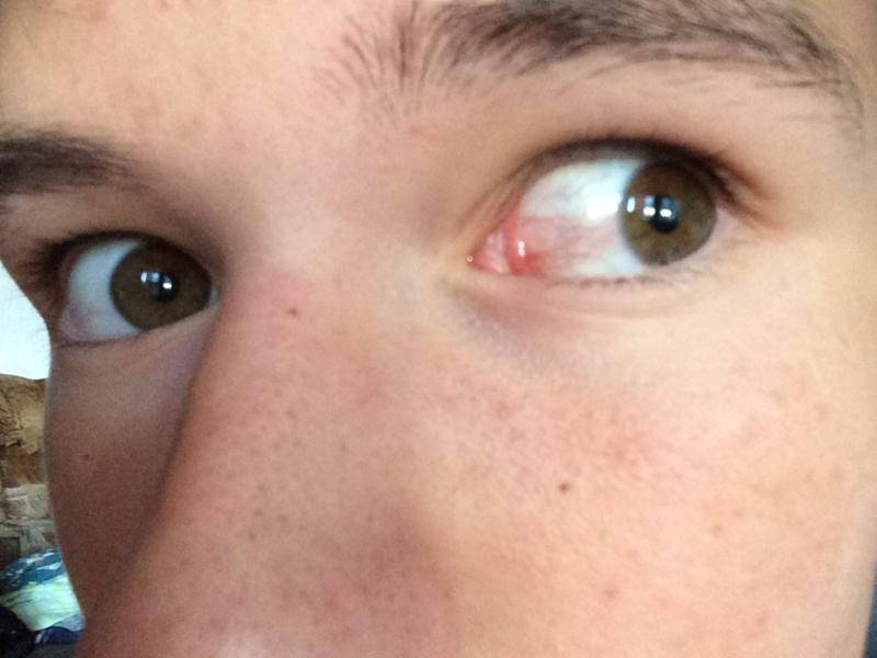 Покраснение глаз - о каких патологиях сигнализирует данный симптом